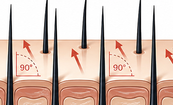 Others — incorrect perpendicular angulation