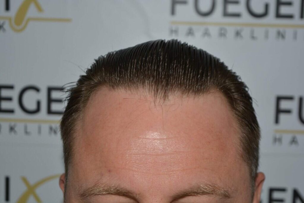 Come And See A Perfect Blond Hairline