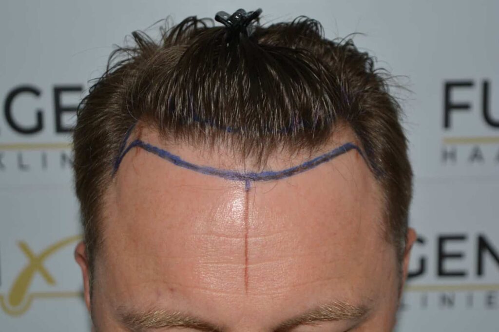 Come And See A Perfect Blond Hairline