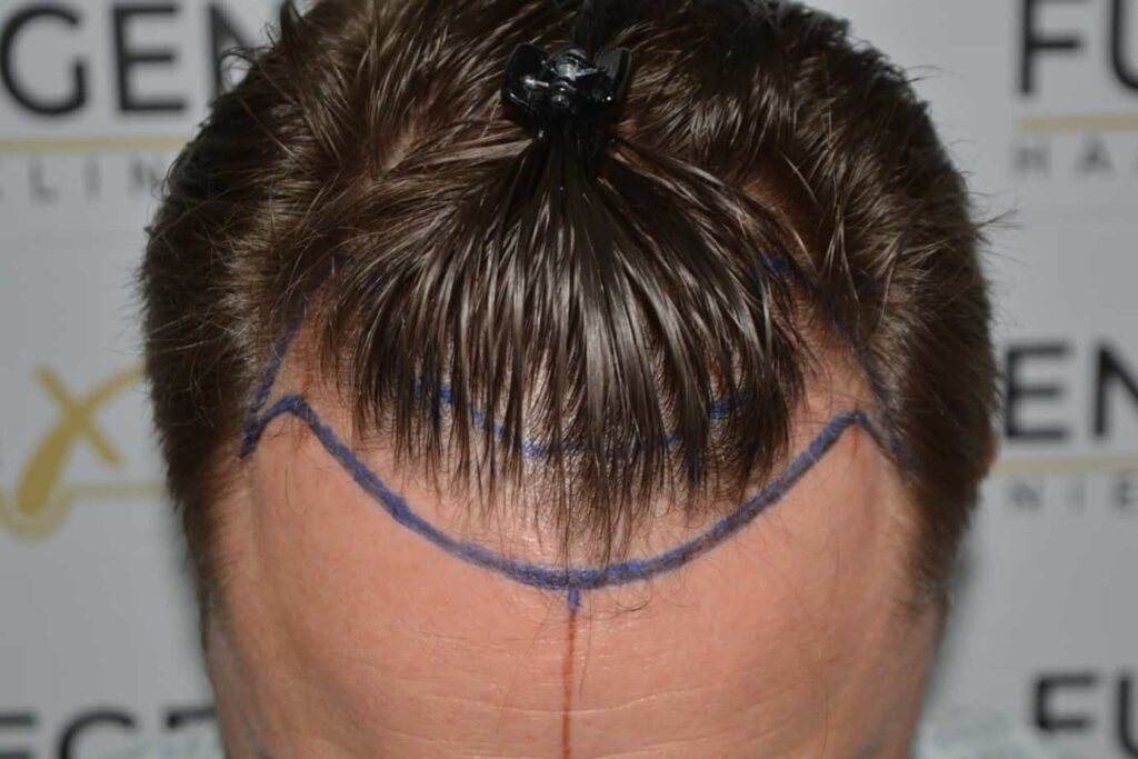 Come And See A Perfect Blond Hairline