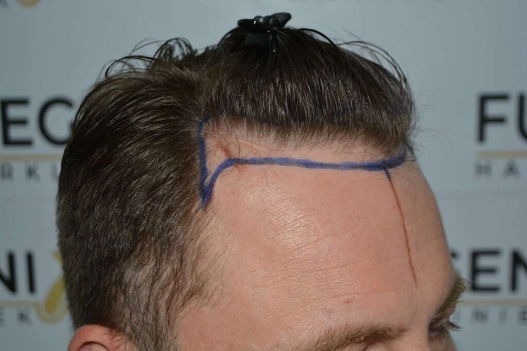 Come And See A Perfect Blond Hairline