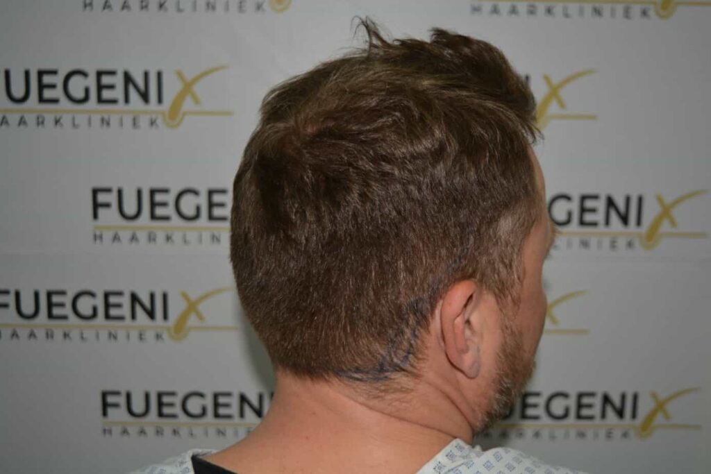 Come And See A Perfect Blond Hairline