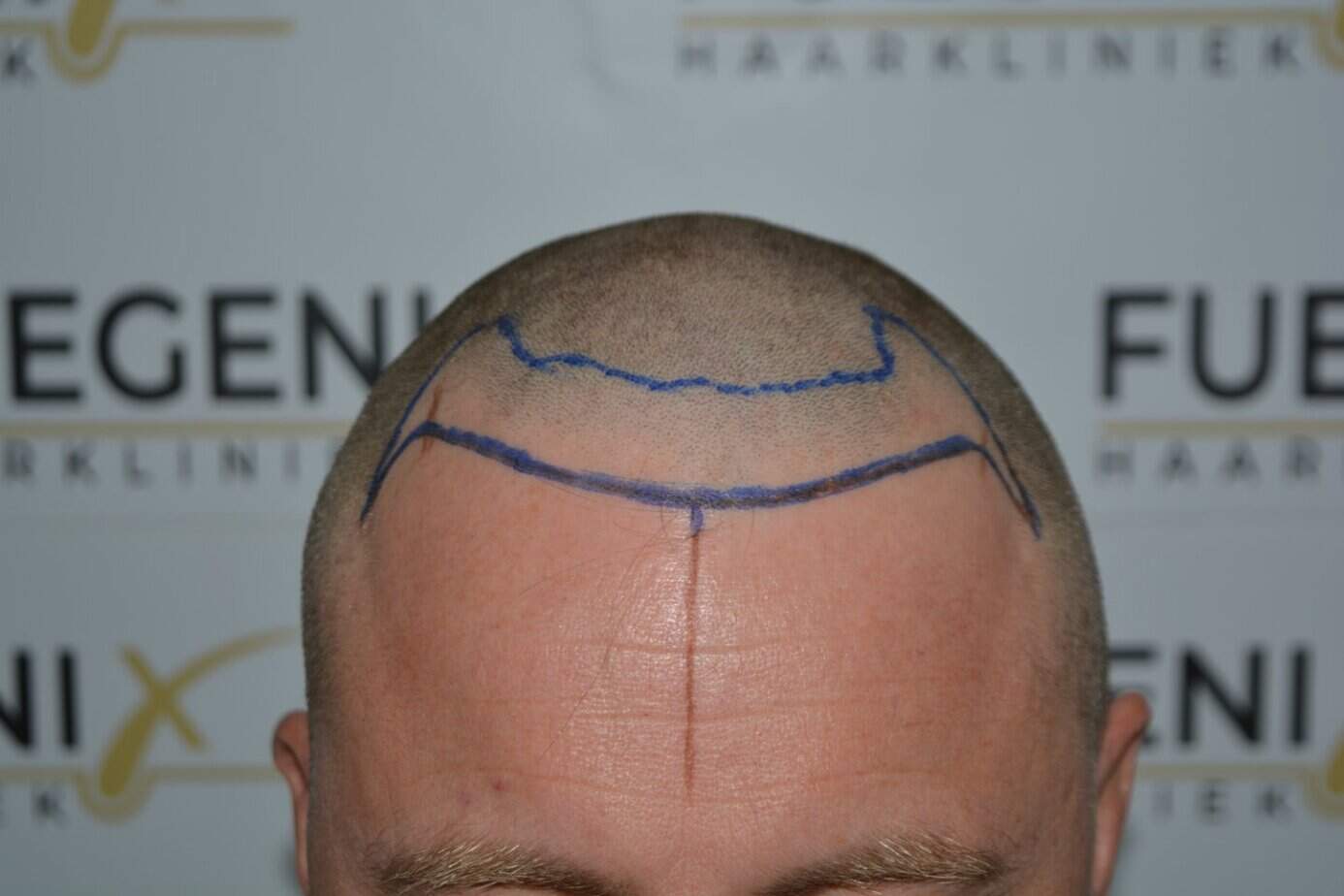 Come And See A Perfect Blond Hairline
