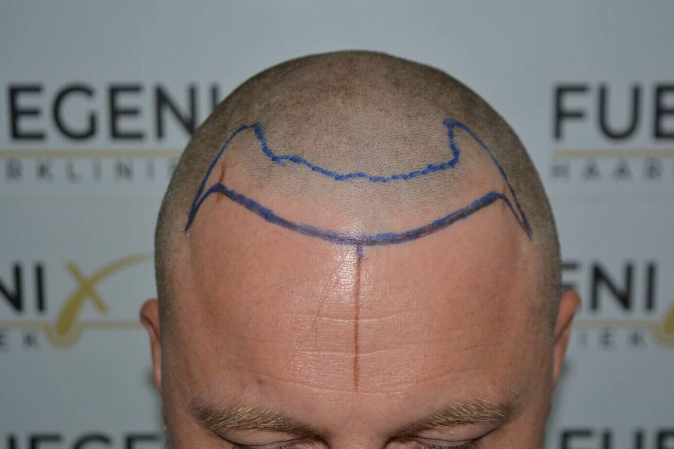 Come And See A Perfect Blond Hairline