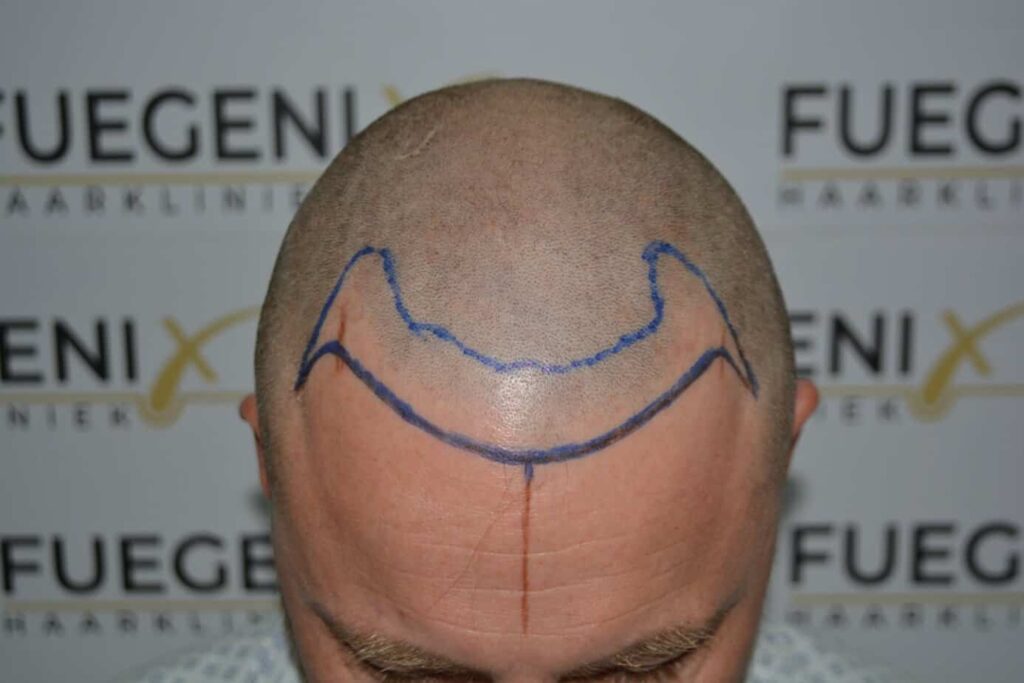 Come And See A Perfect Blond Hairline