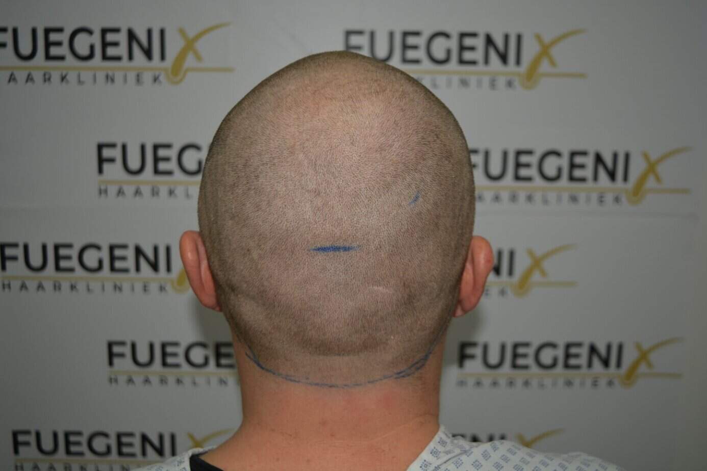 Come And See A Perfect Blond Hairline