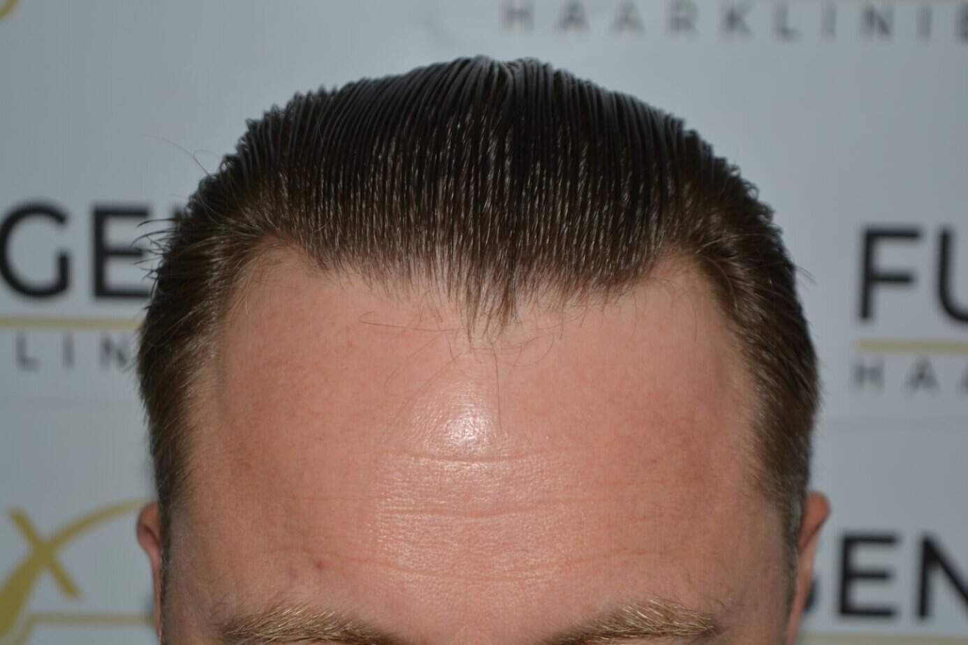 A perfect blond hairline — before