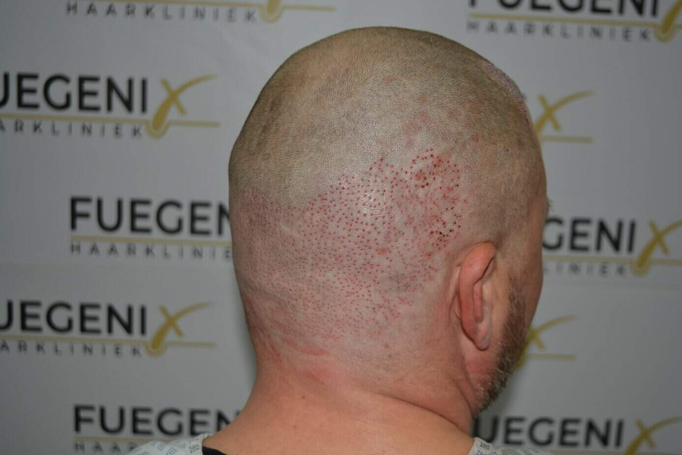 Come And See A Perfect Blond Hairline