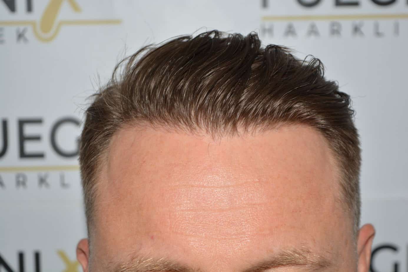 Come And See A Perfect Blond Hairline