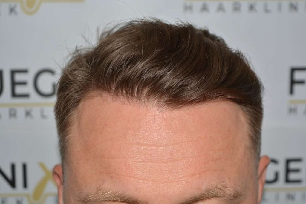 Come And See A Perfect Blond Hairline