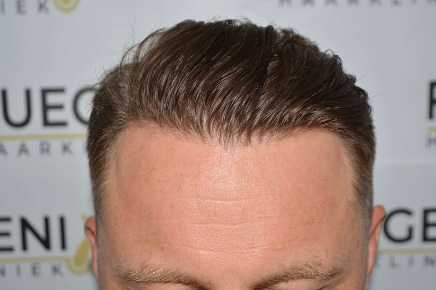 A perfect blond hairline — after