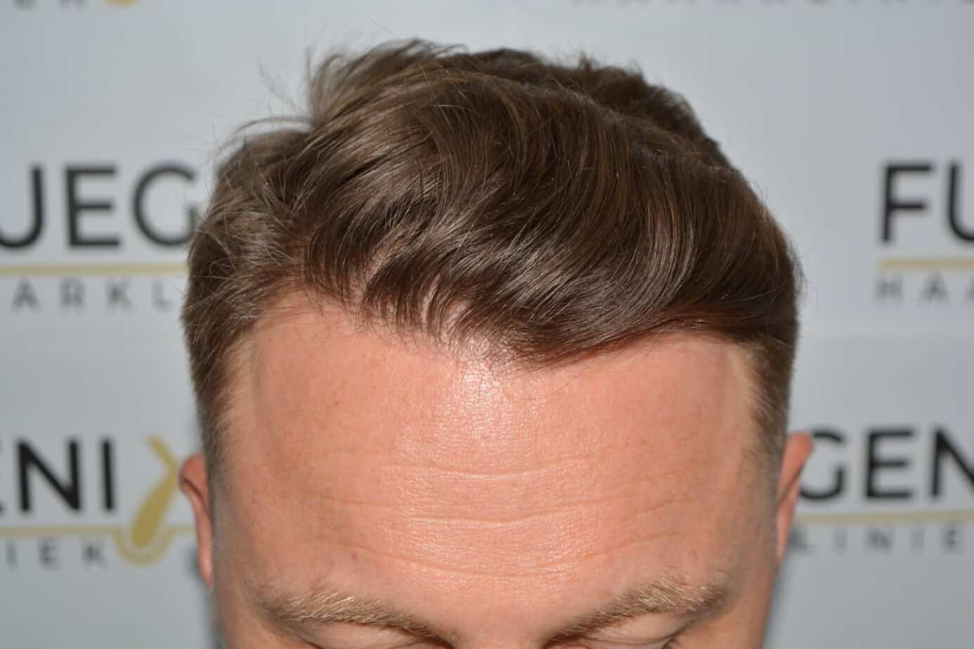 Come And See A Perfect Blond Hairline
