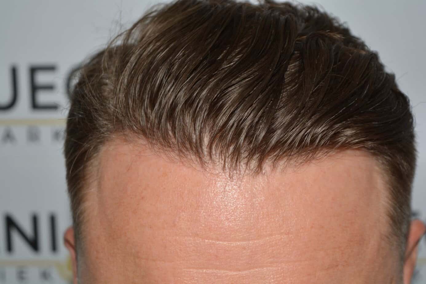 Come And See A Perfect Blond Hairline