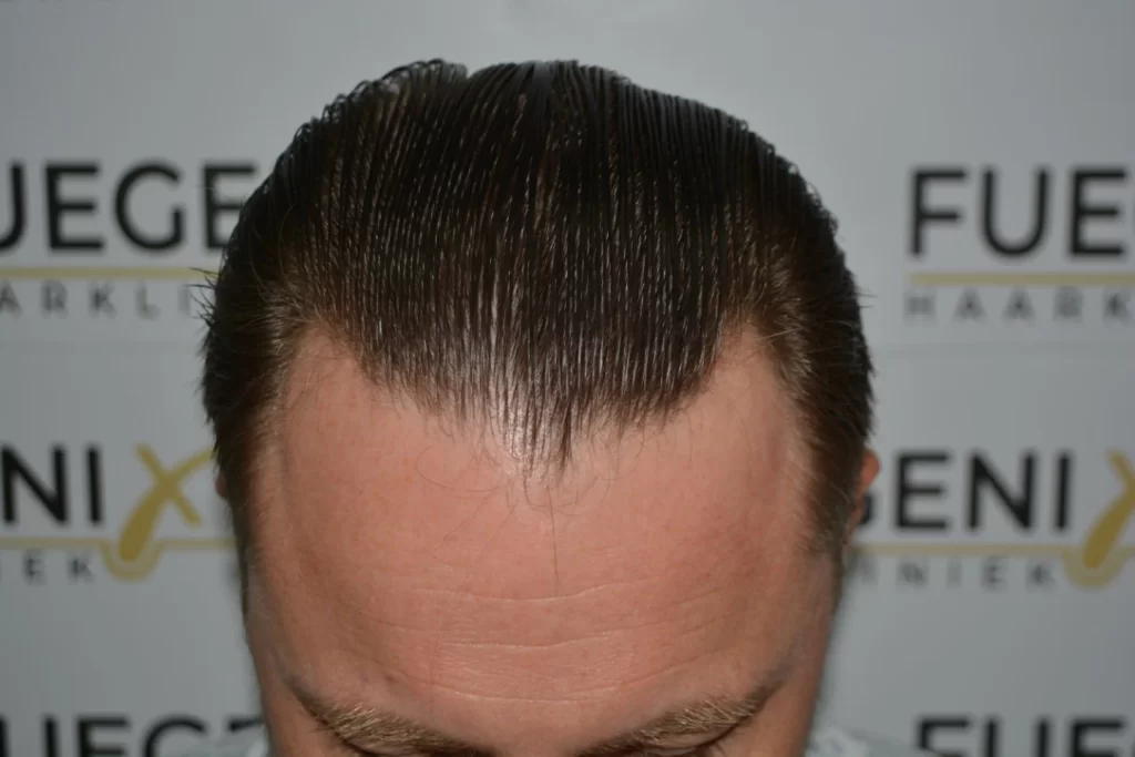 Come And See A Perfect Blond Hairline