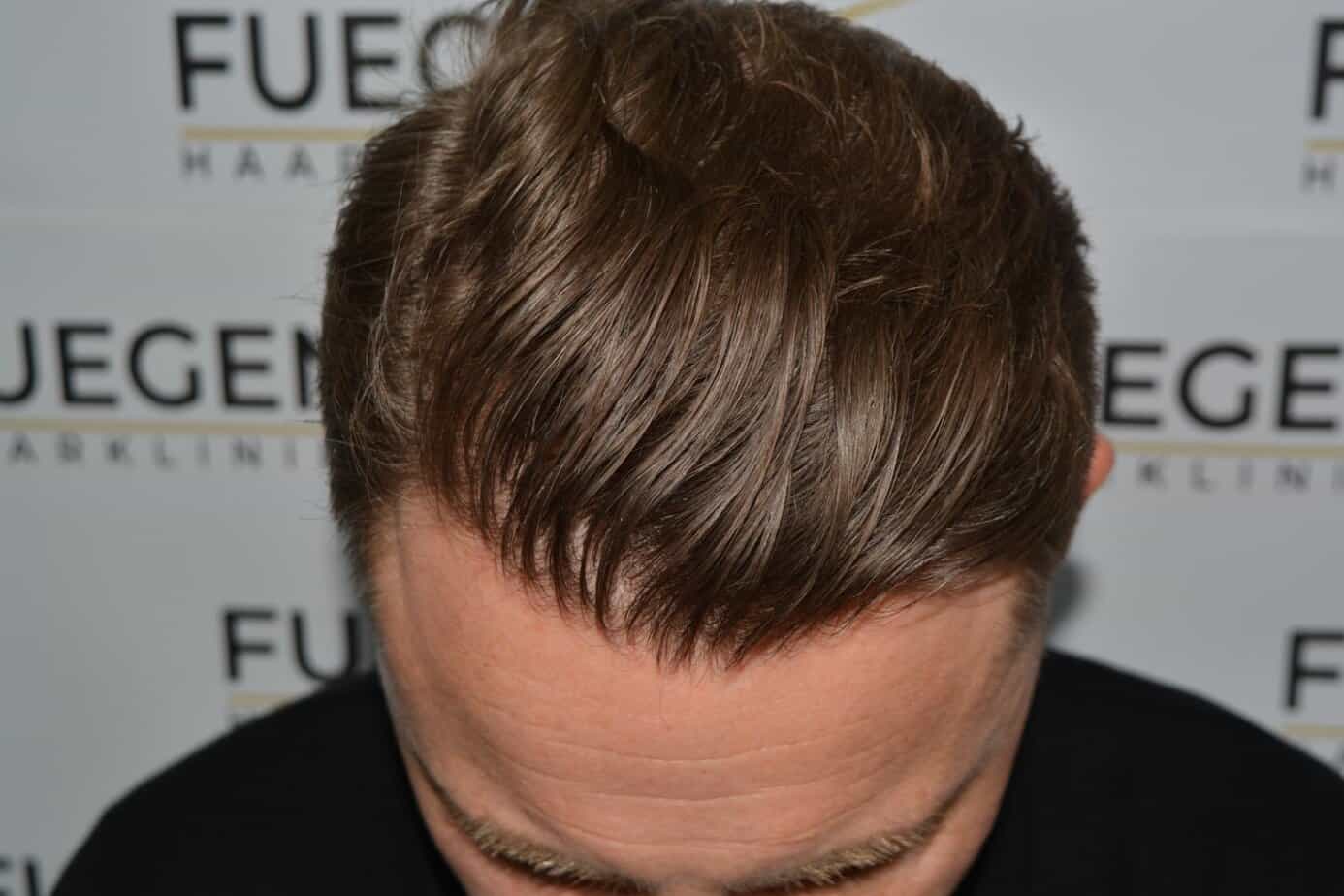 Come And See A Perfect Blond Hairline