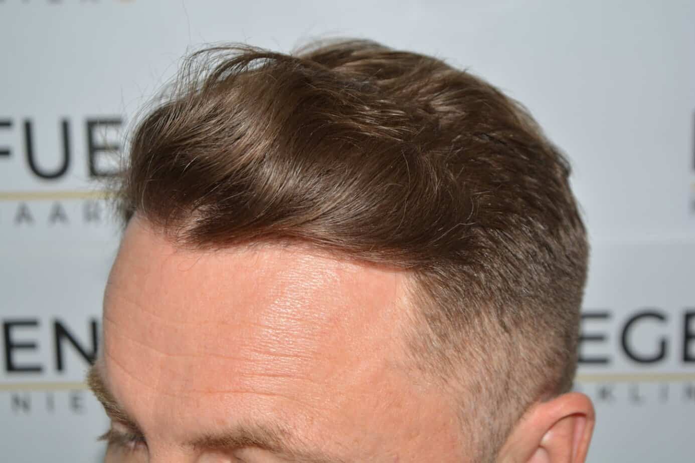 Come And See A Perfect Blond Hairline