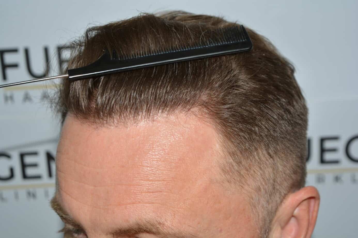 Come And See A Perfect Blond Hairline