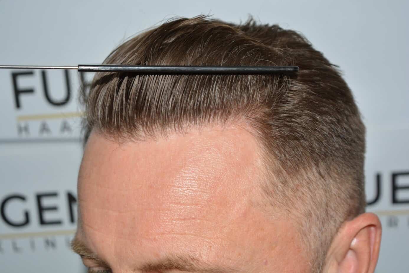 Come And See A Perfect Blond Hairline