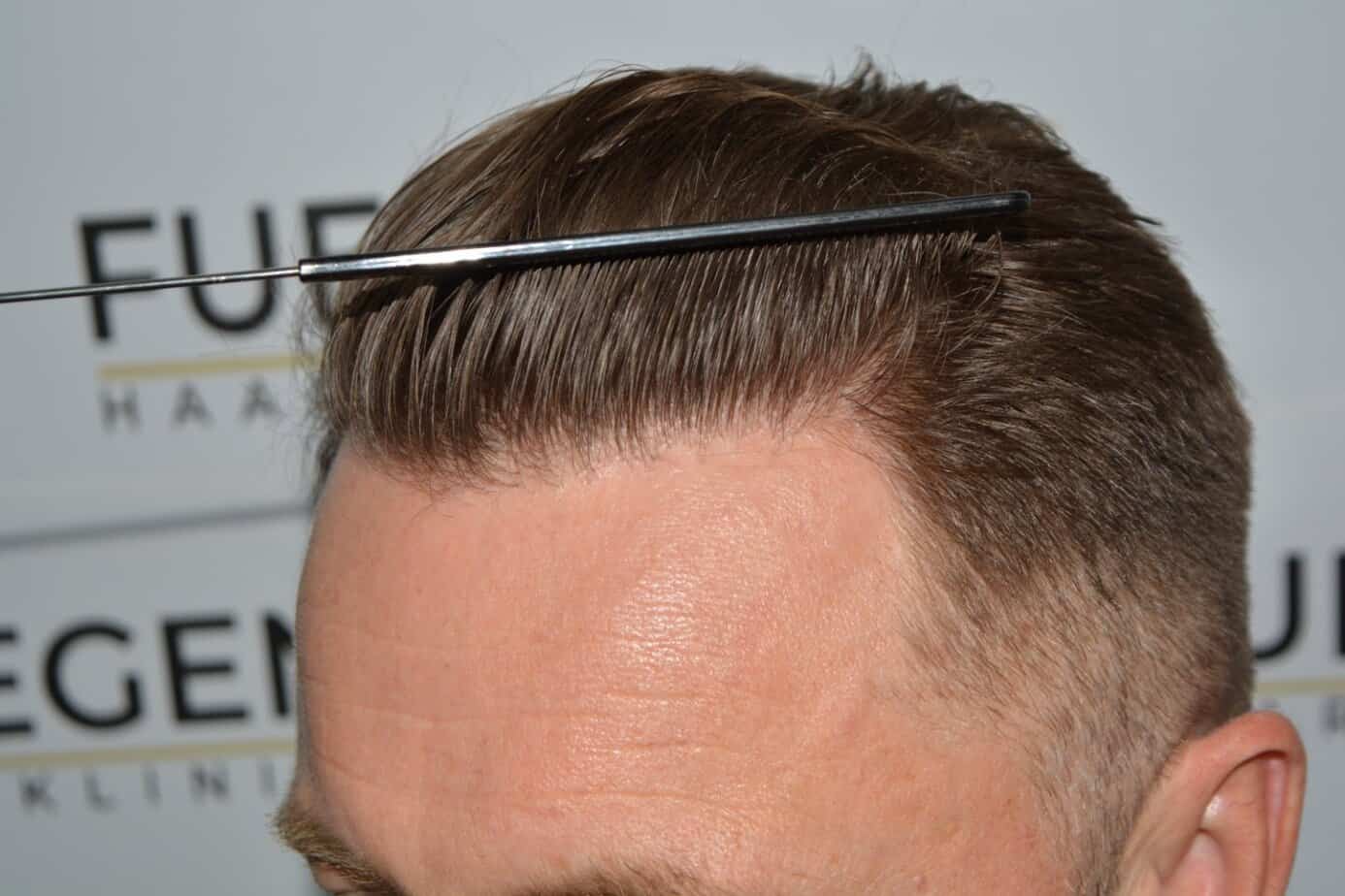 Come And See A Perfect Blond Hairline