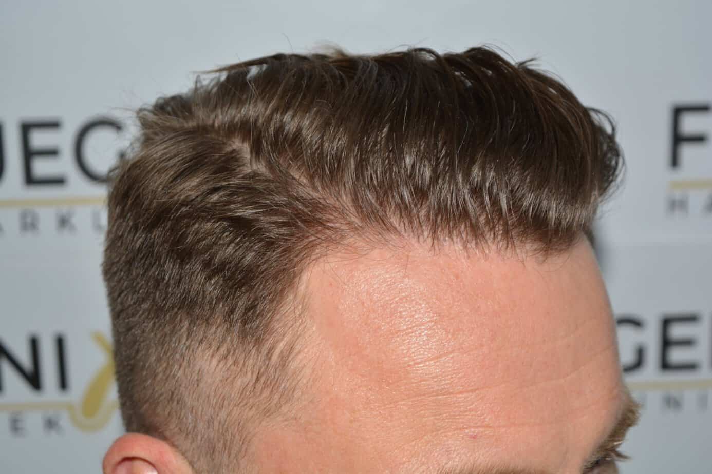 Come And See A Perfect Blond Hairline