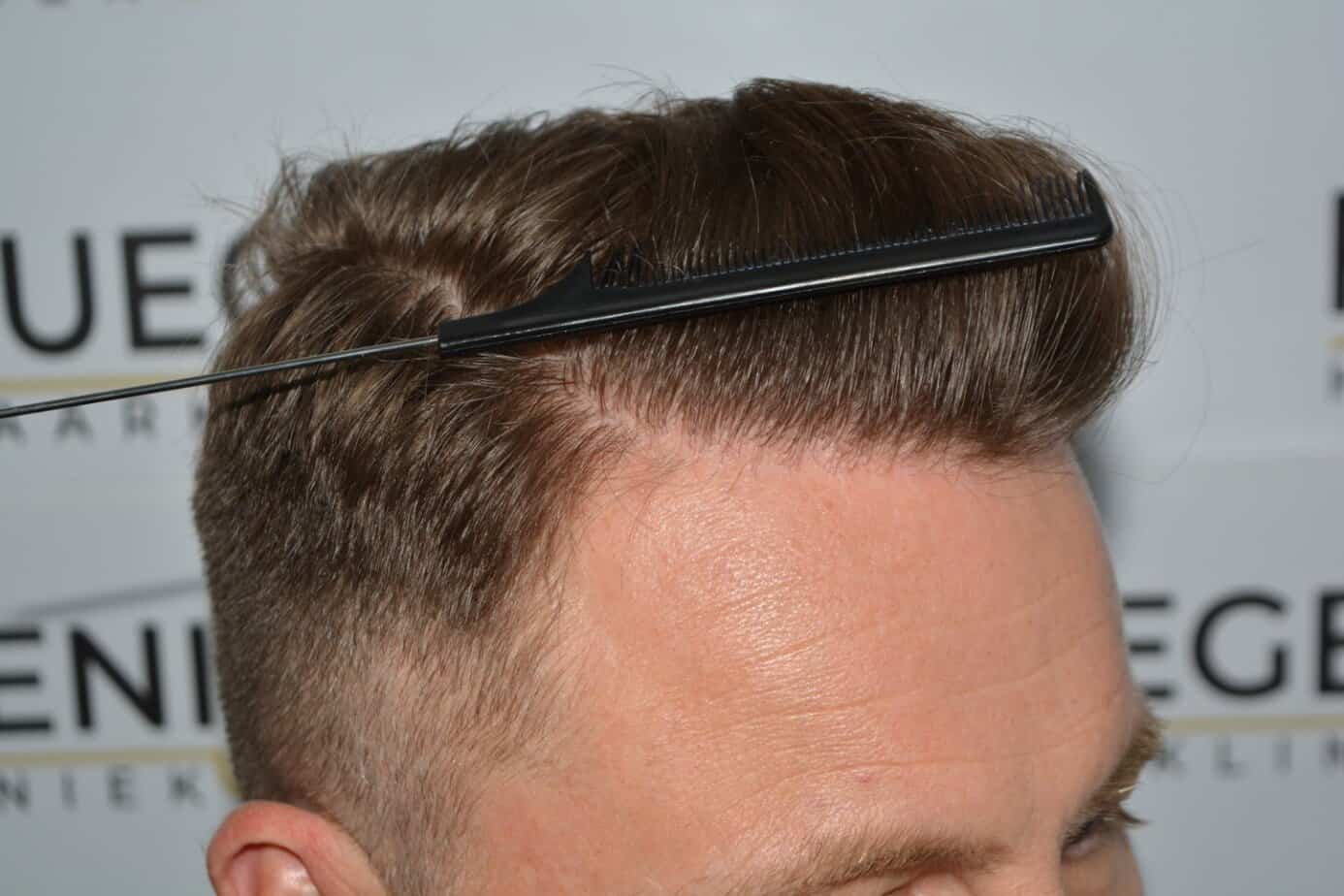Come And See A Perfect Blond Hairline