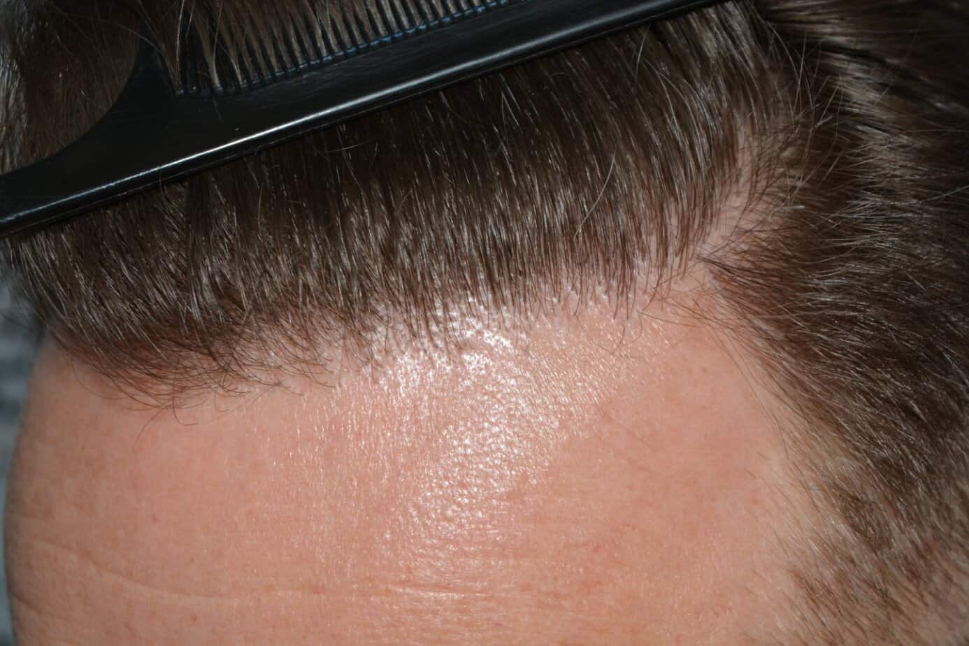 Come And See A Perfect Blond Hairline