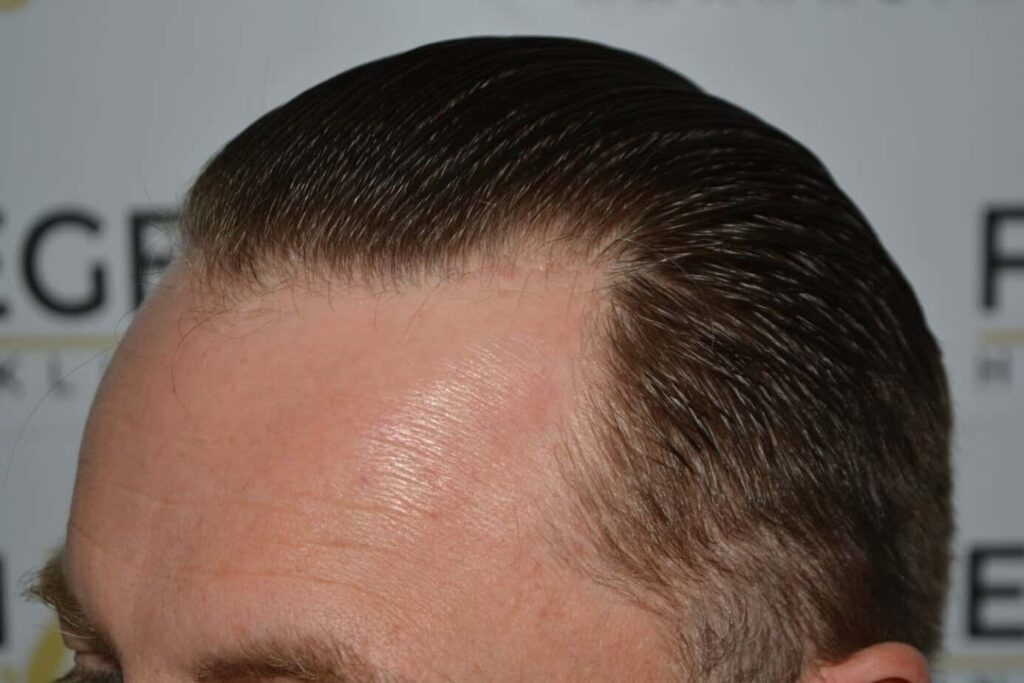 Come And See A Perfect Blond Hairline