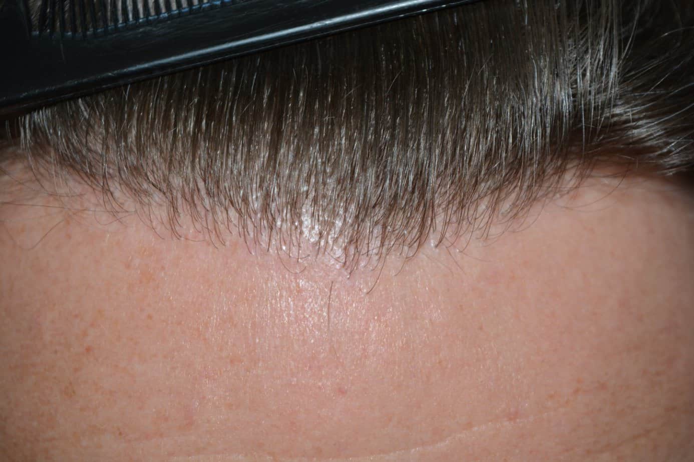 Come And See A Perfect Blond Hairline