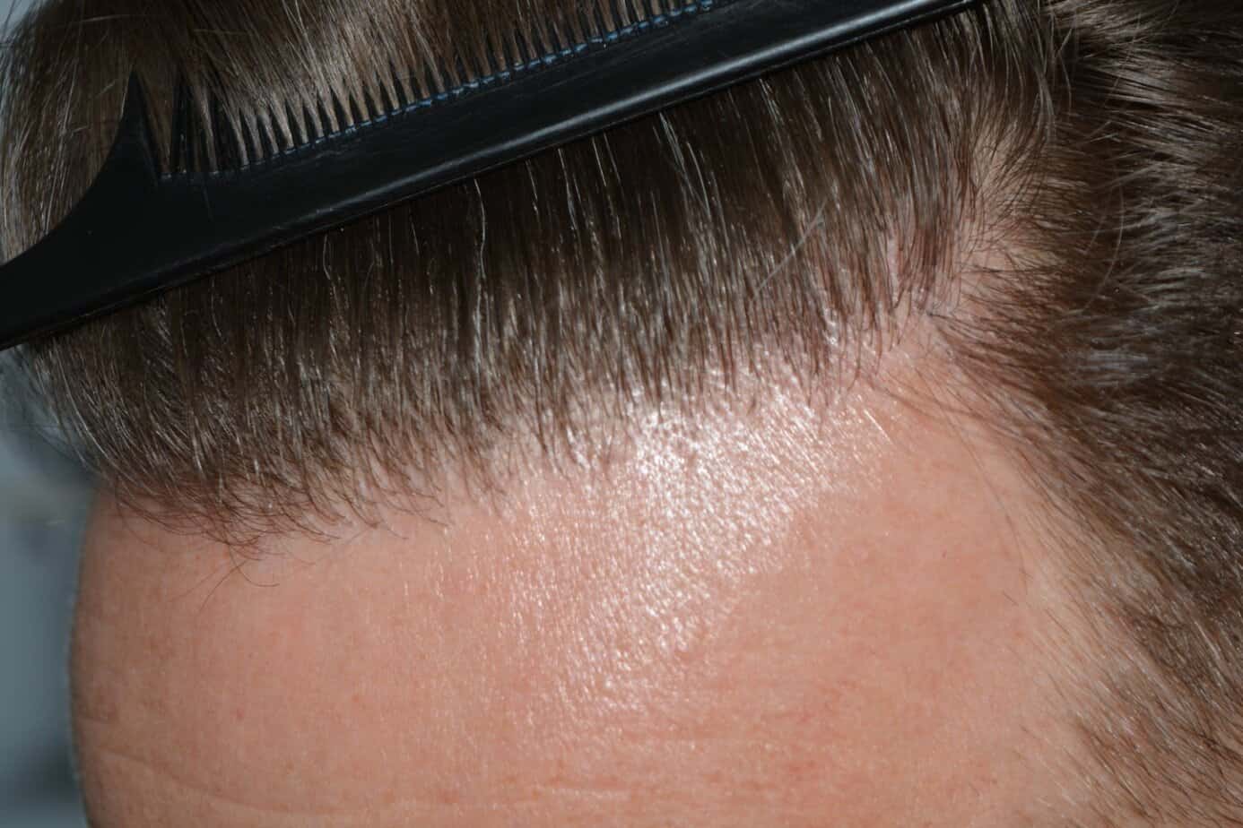 Come And See A Perfect Blond Hairline