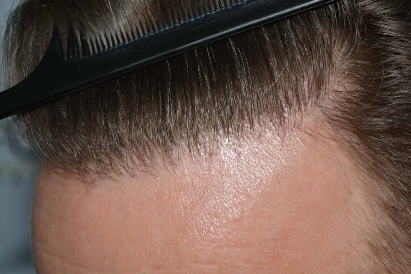 Come And See A Perfect Blond Hairline