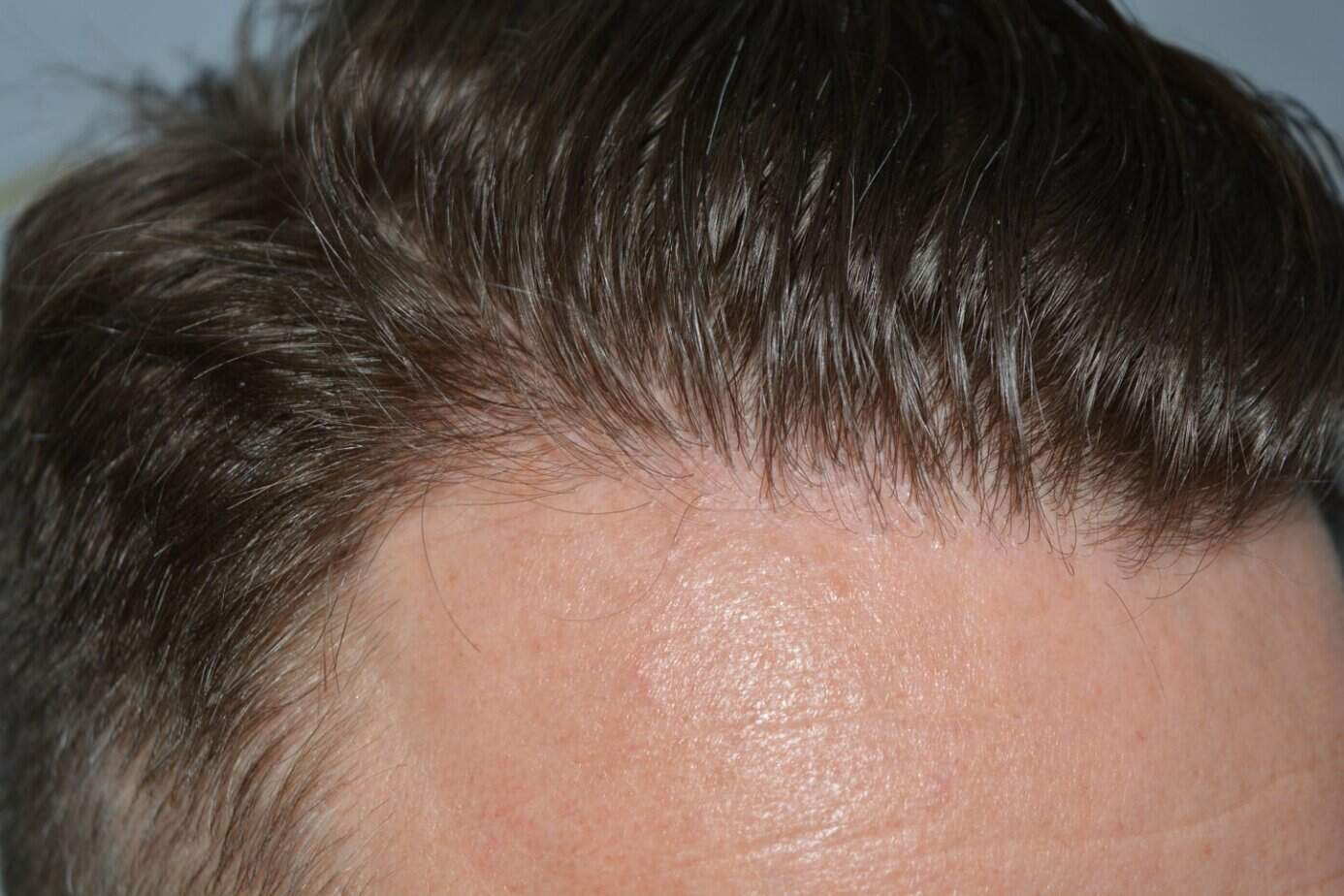 Come And See A Perfect Blond Hairline