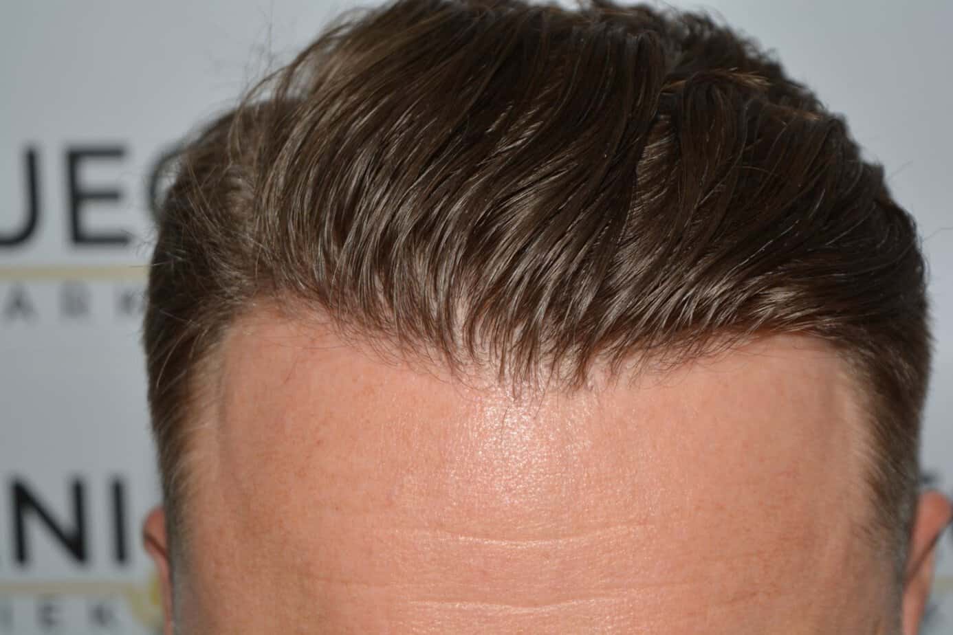 Come And See A Perfect Blond Hairline