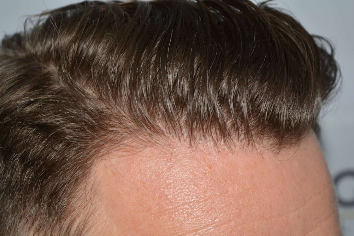 Come And See A Perfect Blond Hairline