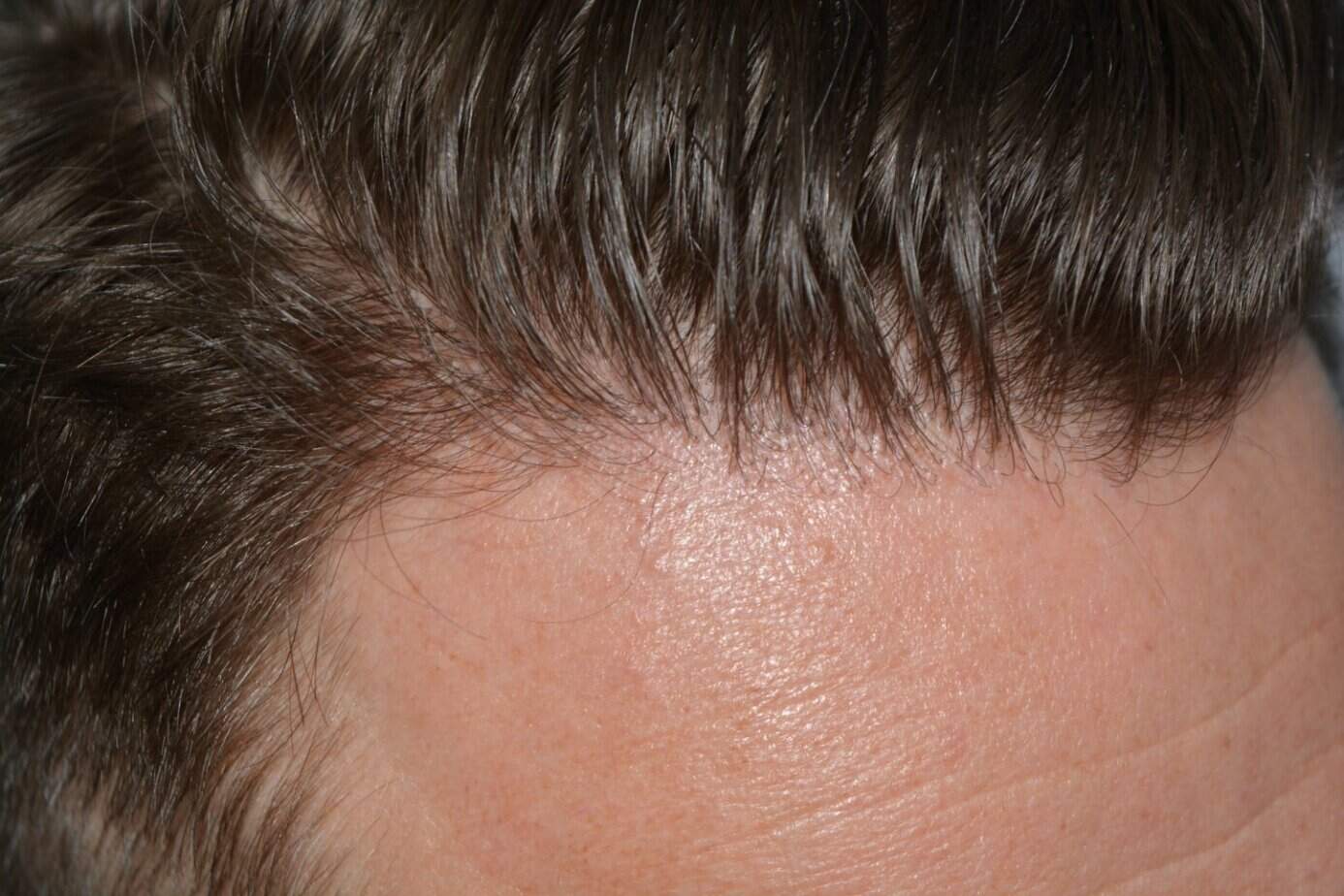 Come And See A Perfect Blond Hairline