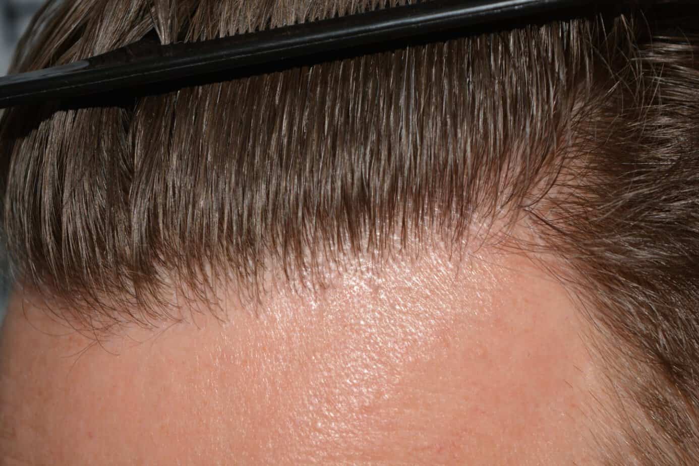 Come And See A Perfect Blond Hairline