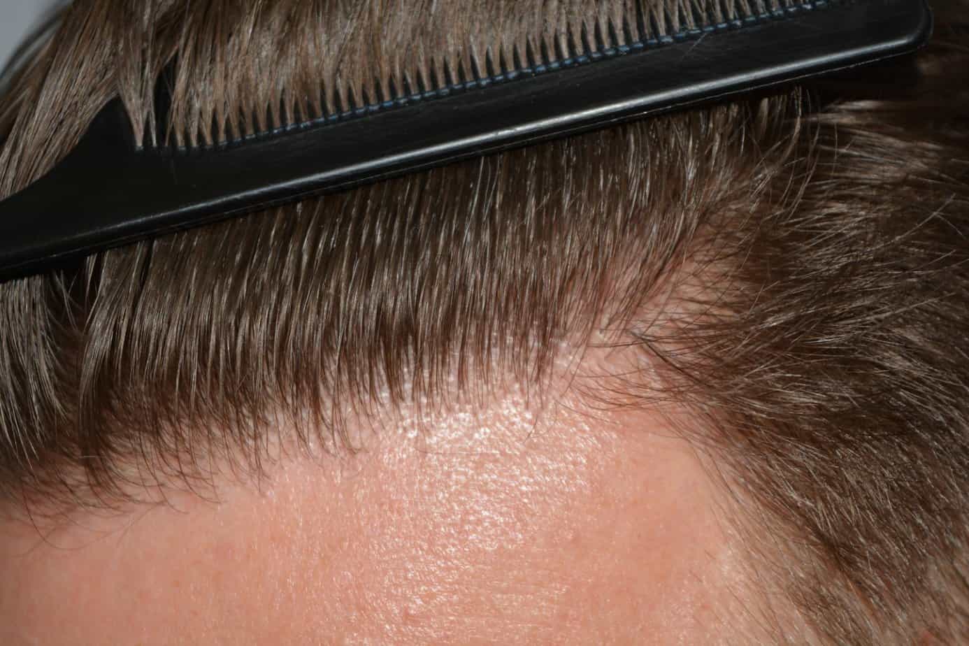Come And See A Perfect Blond Hairline