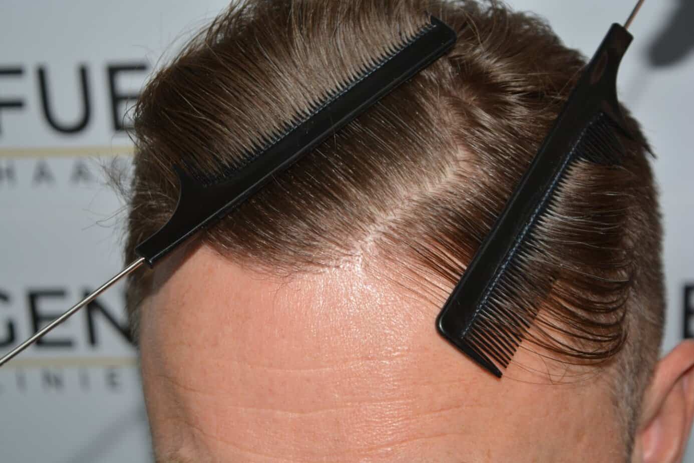 Come And See A Perfect Blond Hairline