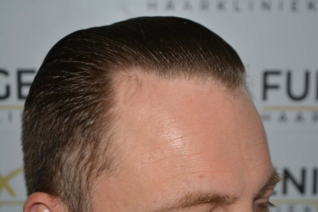 Come And See A Perfect Blond Hairline