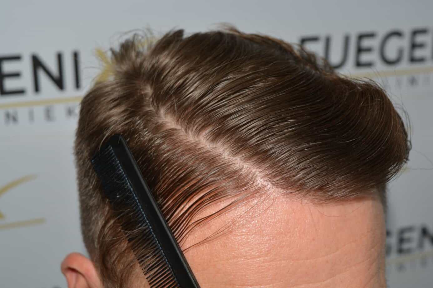 Come And See A Perfect Blond Hairline