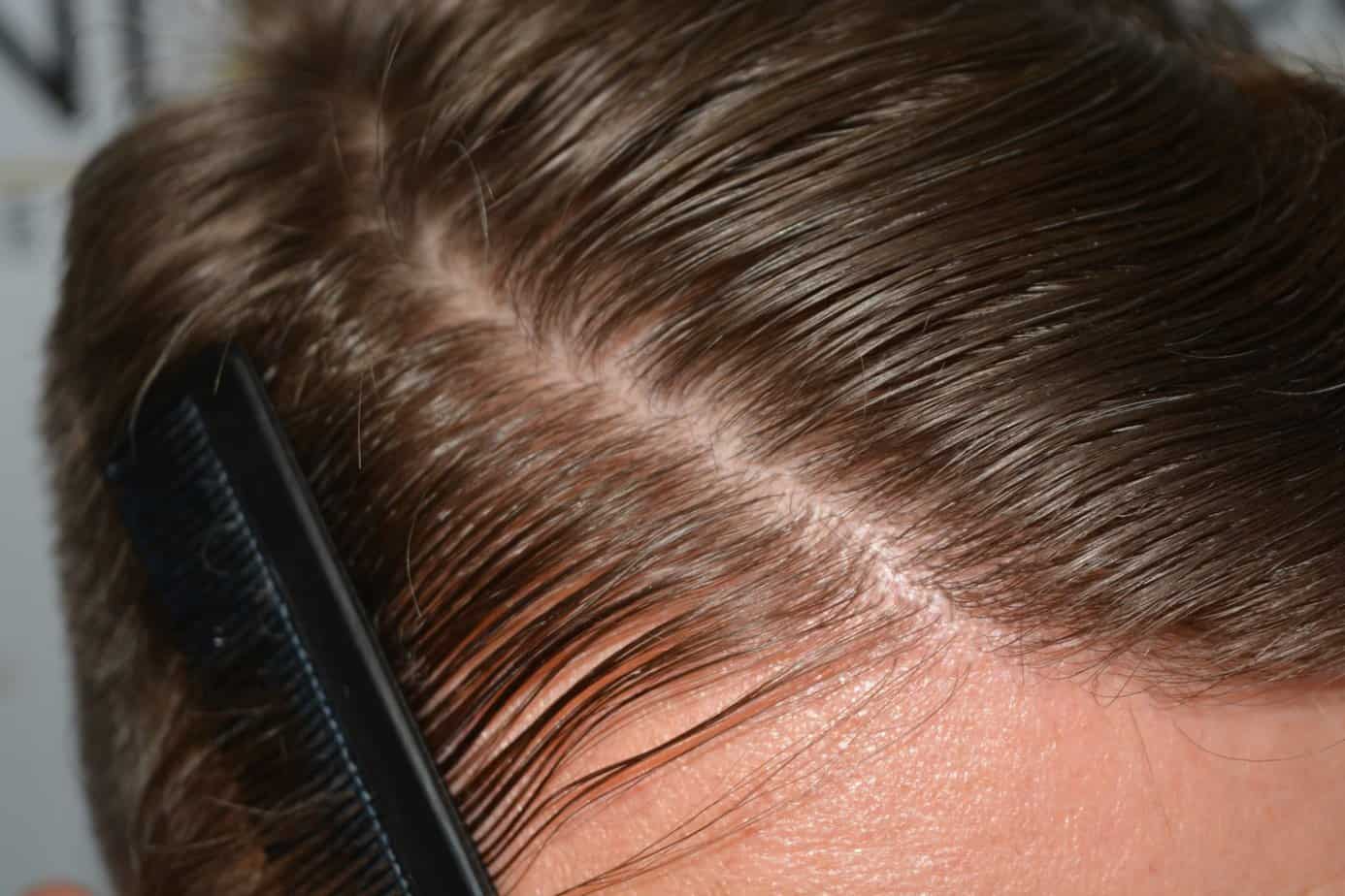 Come And See A Perfect Blond Hairline