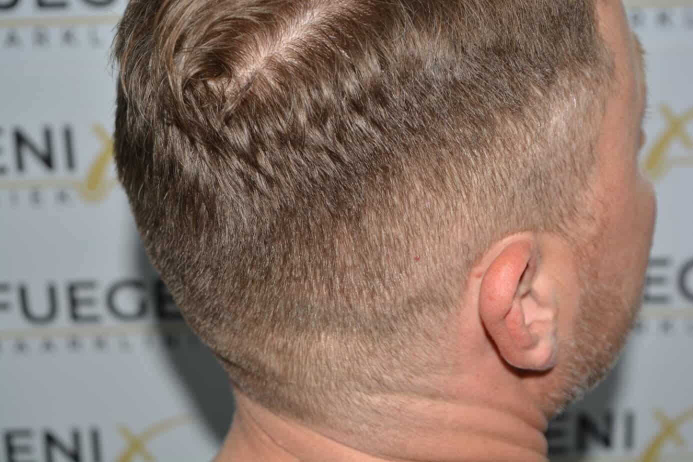 Come And See A Perfect Blond Hairline
