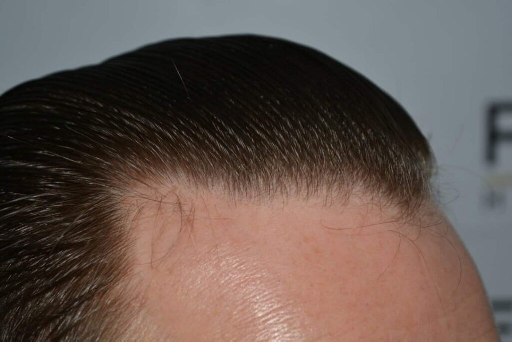 Come And See A Perfect Blond Hairline