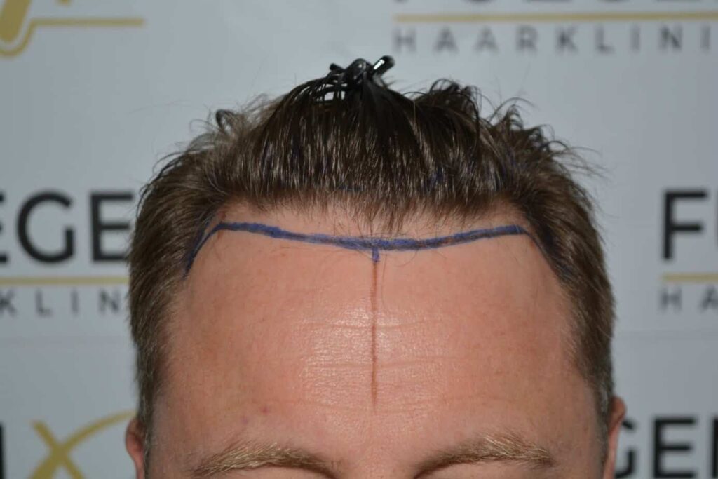 Come And See A Perfect Blond Hairline