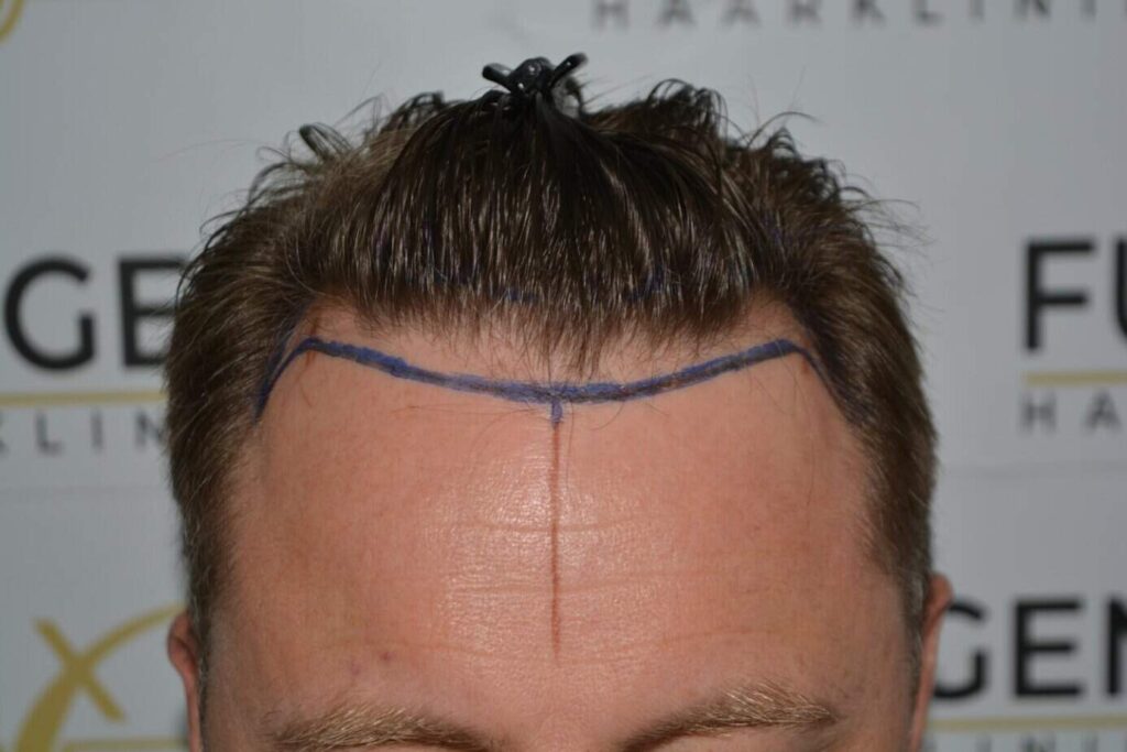 Come And See A Perfect Blond Hairline