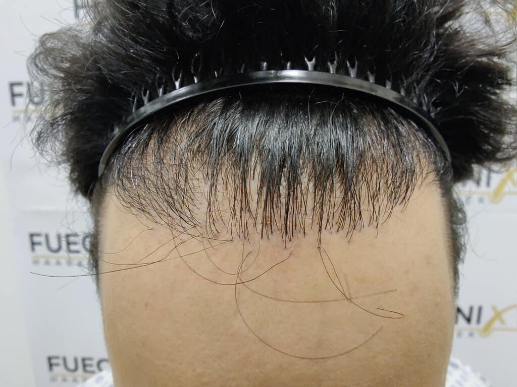 Before – One Surgery Repair