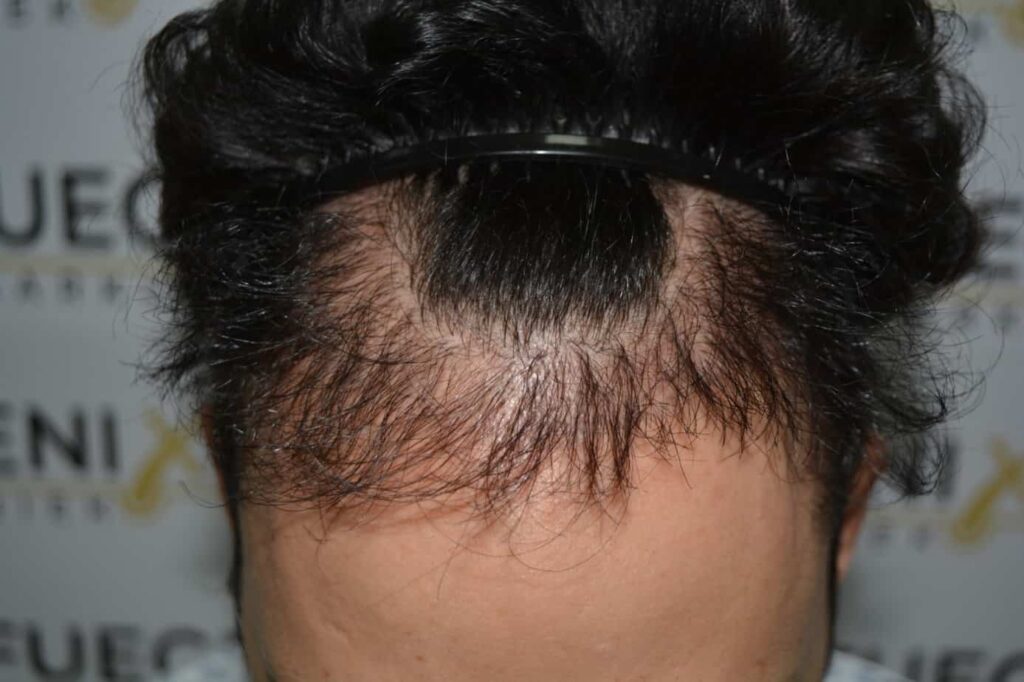 One Surgery Repair