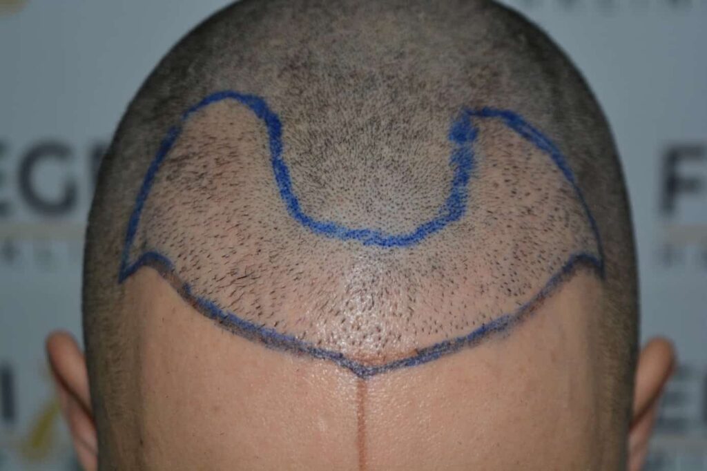 One Surgery Repair