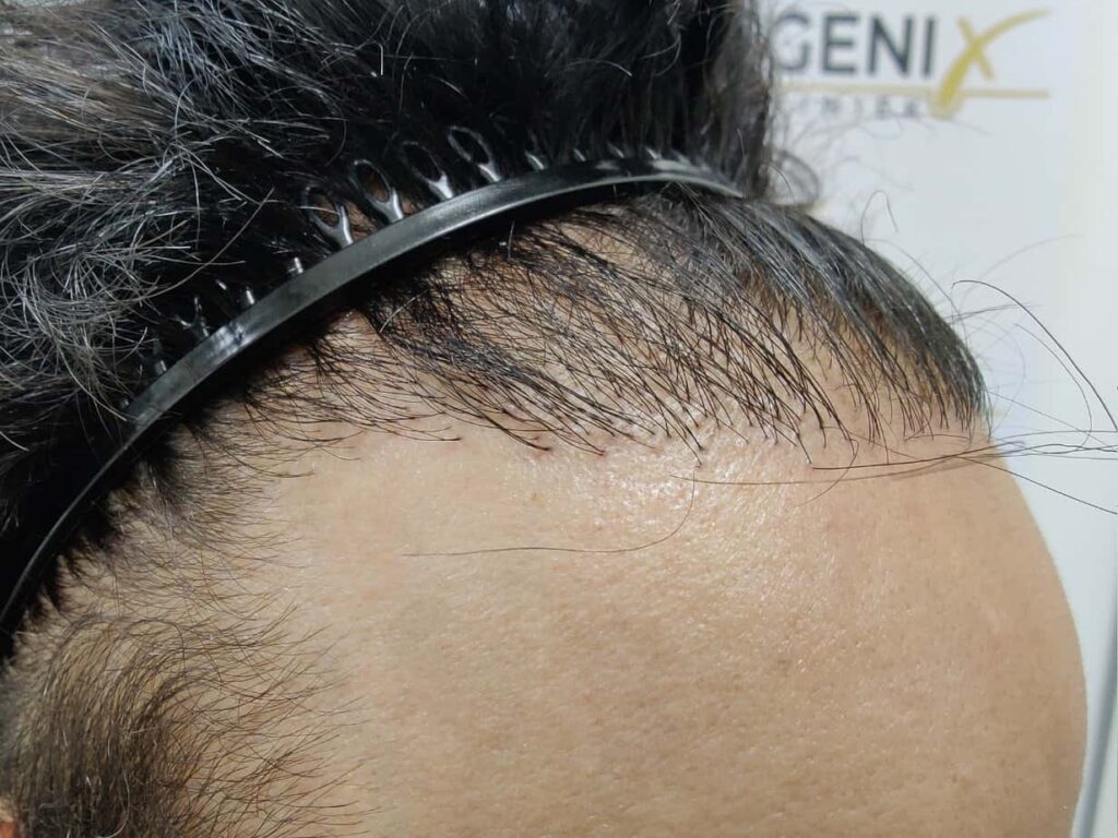 One Surgery Repair