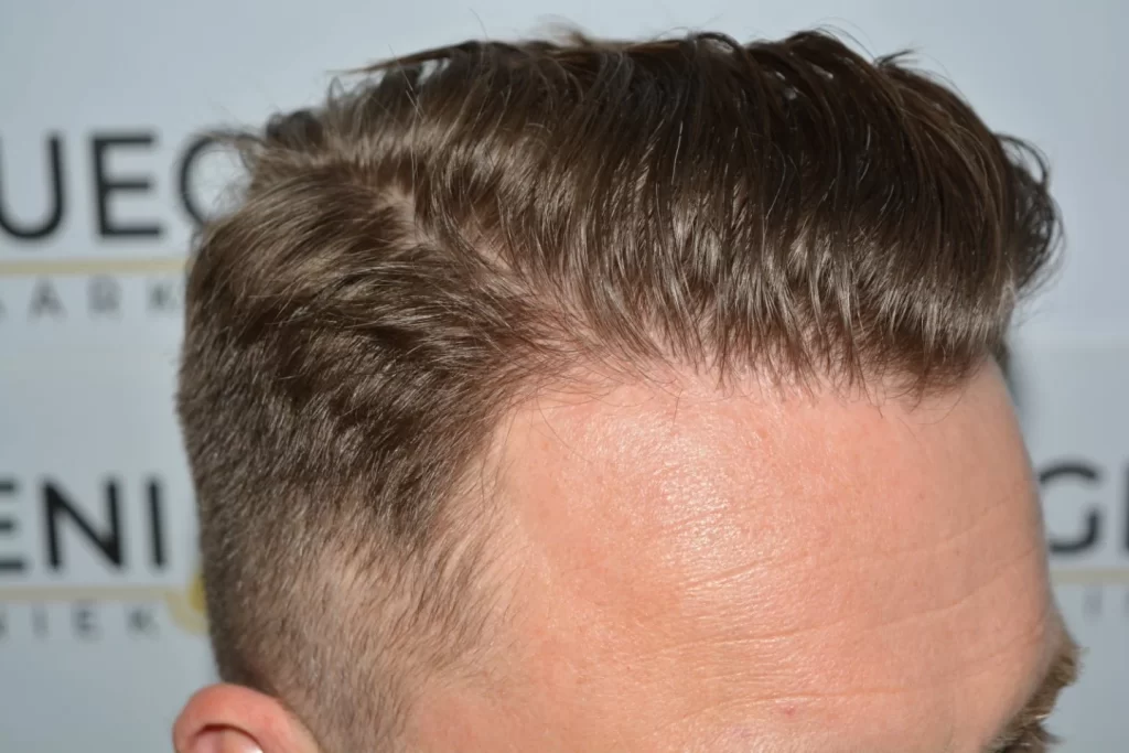 Come And See A Perfect Blond Hairline