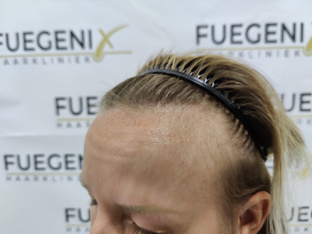 Female Hairline Lowering FUE